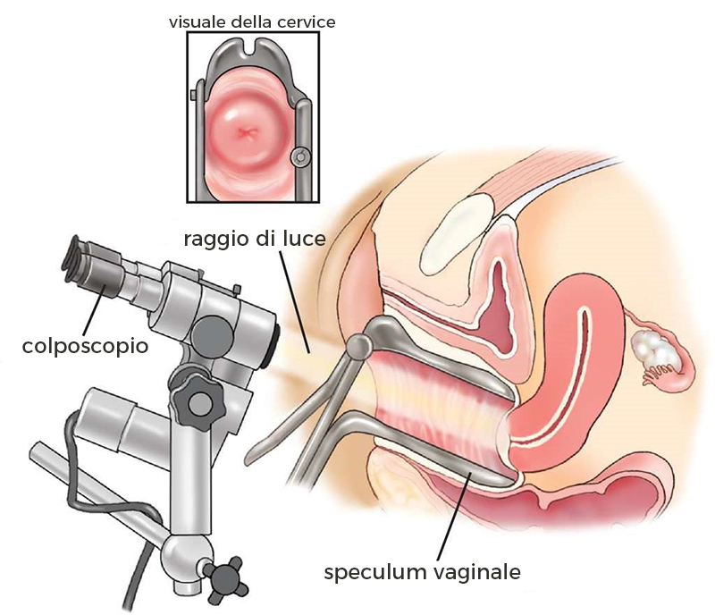 colposcopia